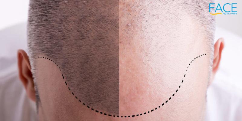 Top-down view of a man's scalp with a dotted line tracing a receding hairline