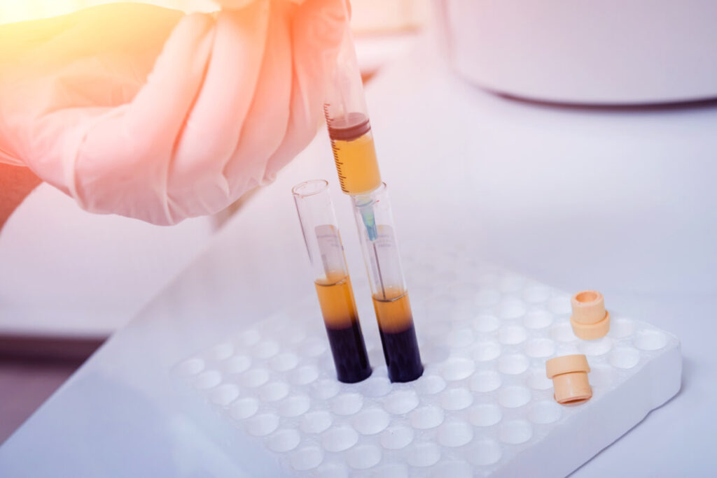 Does The Cartilage Reattach To The Bone With PRP?