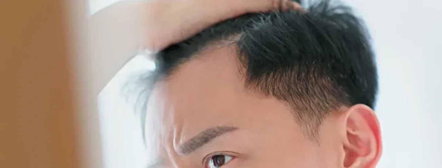 Does Platelet-Rich Plasma Work for Receding Hairline?