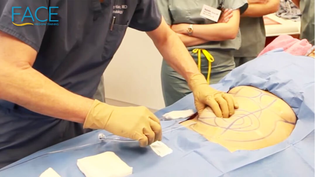 Microcannula Liposuction: A New Form Of Medical Liposculpture