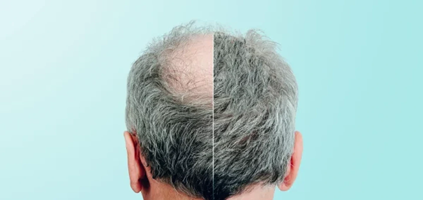 PRP and Hair Transplants: What You Need to Know About Minimally Invasive vs. Surgical Hair Loss Treatments 