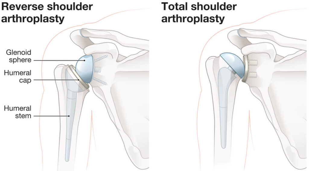 Shoulder Arthroplasty, Autologous Stem Cells, PRP, And Viscosupplementation – What’s The Best For Osteoarthritis?