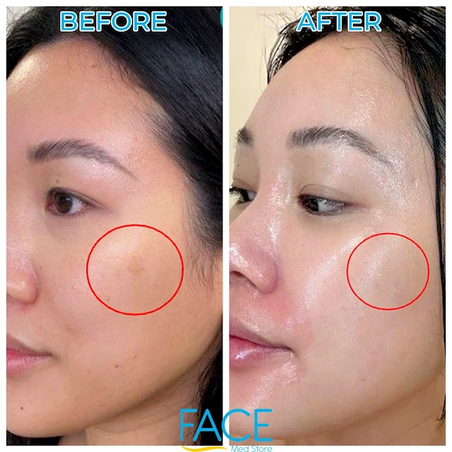 Rejuran patient result