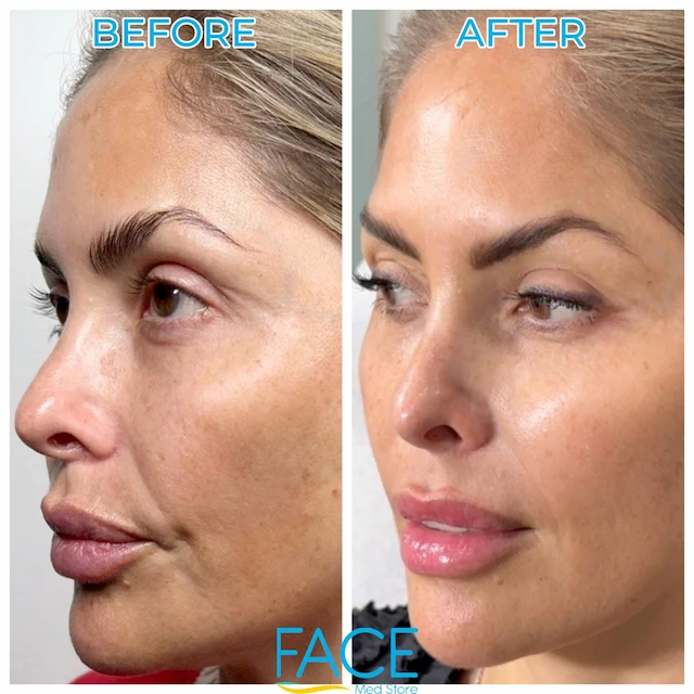 Rejuran patient result
