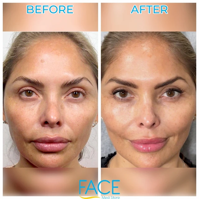 Rejuran patient result