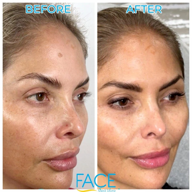 Rejuran patient result