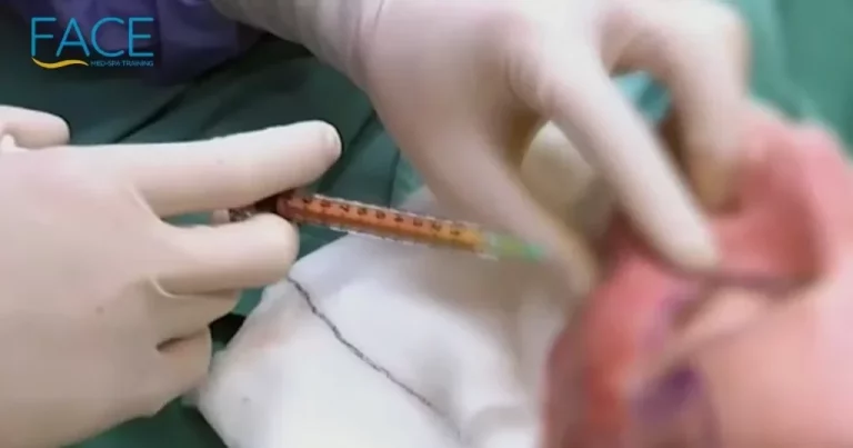 cannula injected