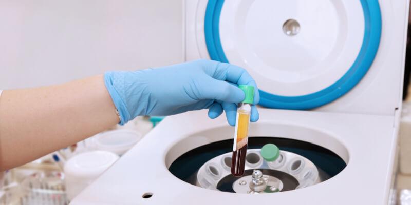 Medical tube with blood plasma in hand for PRP extracted from medical centrifuge for plasma lifting