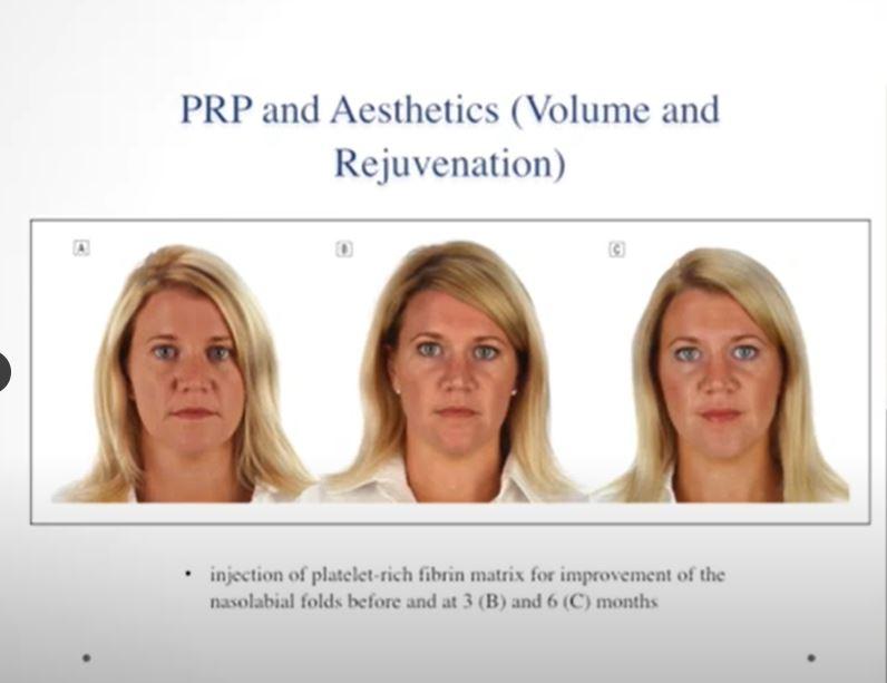 Platelet Rich Plasma (PRP) Platelet Rich Fibrin Matrix (PRFM) in Regenerative Medicine Video Course