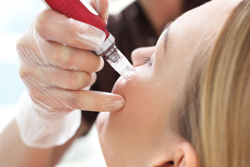 woman getting microneedling done on her face