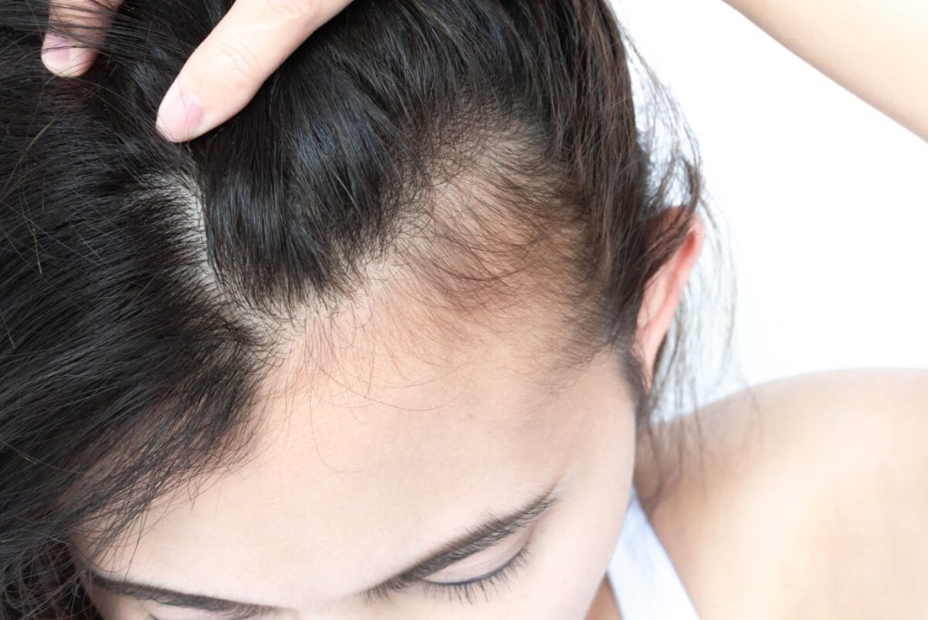 Woman serious hair loss problem