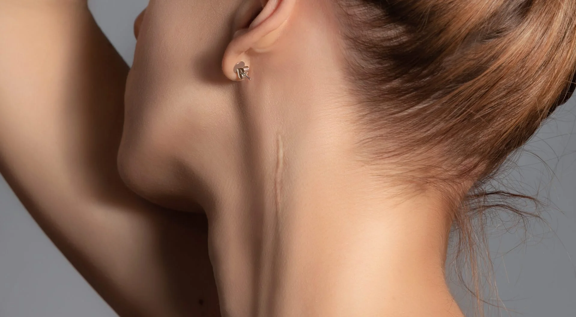 Woman with surgery scar at her neck