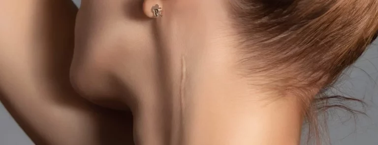 Woman with surgery scar at her neck