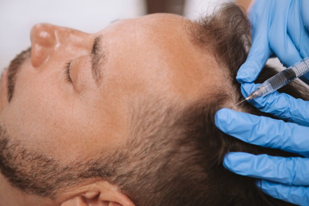 PRP Scalp Injection Treatment Procedure