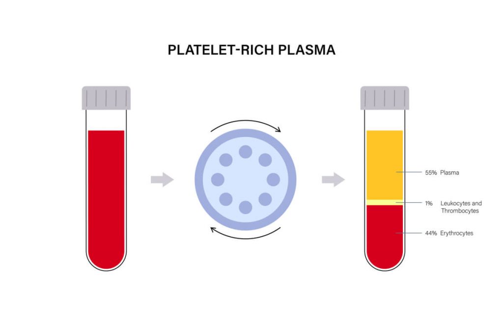 Separation of erythrocytes, red blood cells by centrifugation.