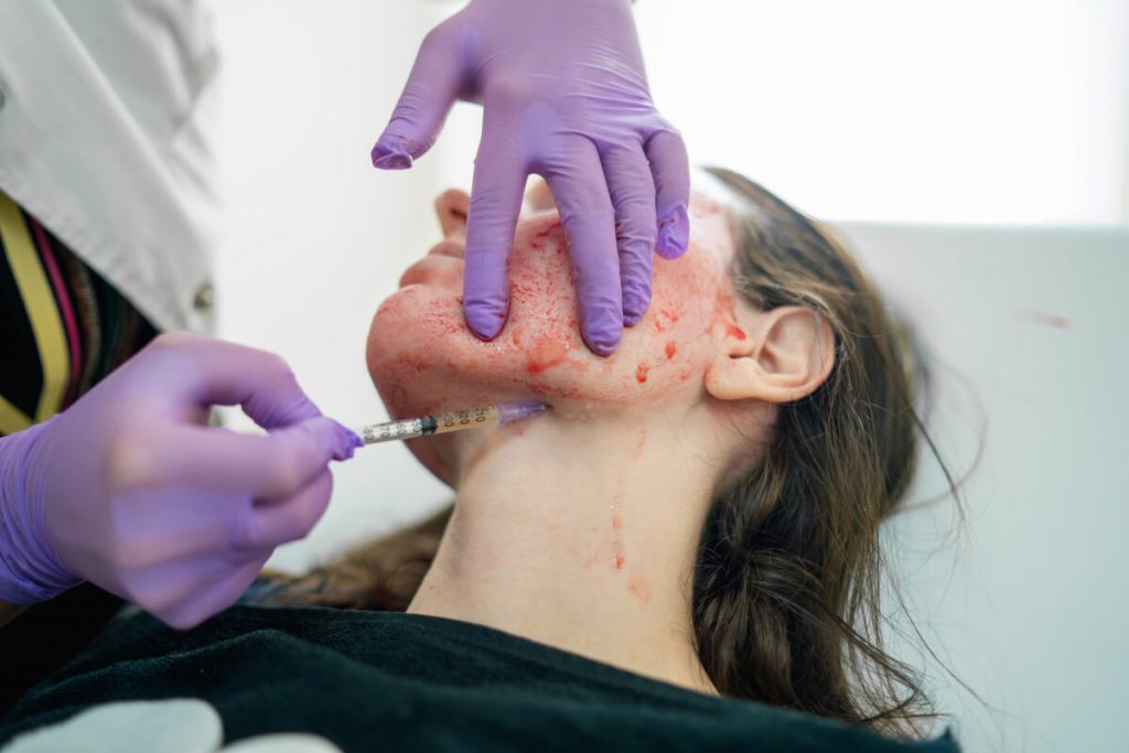 Doctor applying blood plasma during PRP vampire facelift.