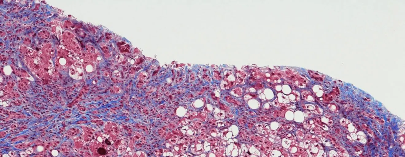 Cirrhosis of the liver with hepatic steatosis and chronic hepatitis