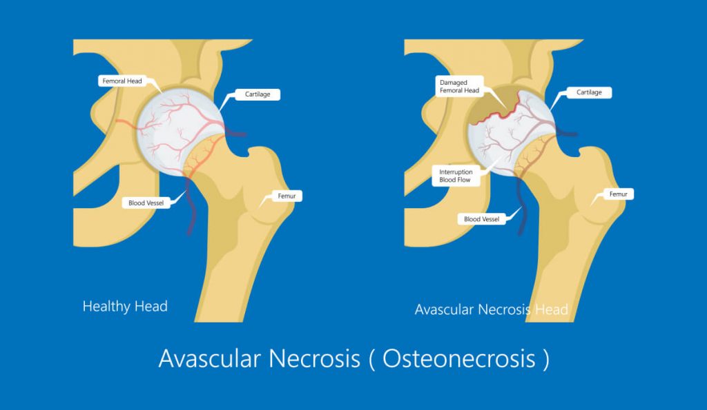 Avascular necrosis