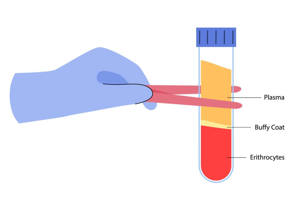 Blood composition in proportions, plasma, buffy coat, erythrocytes.