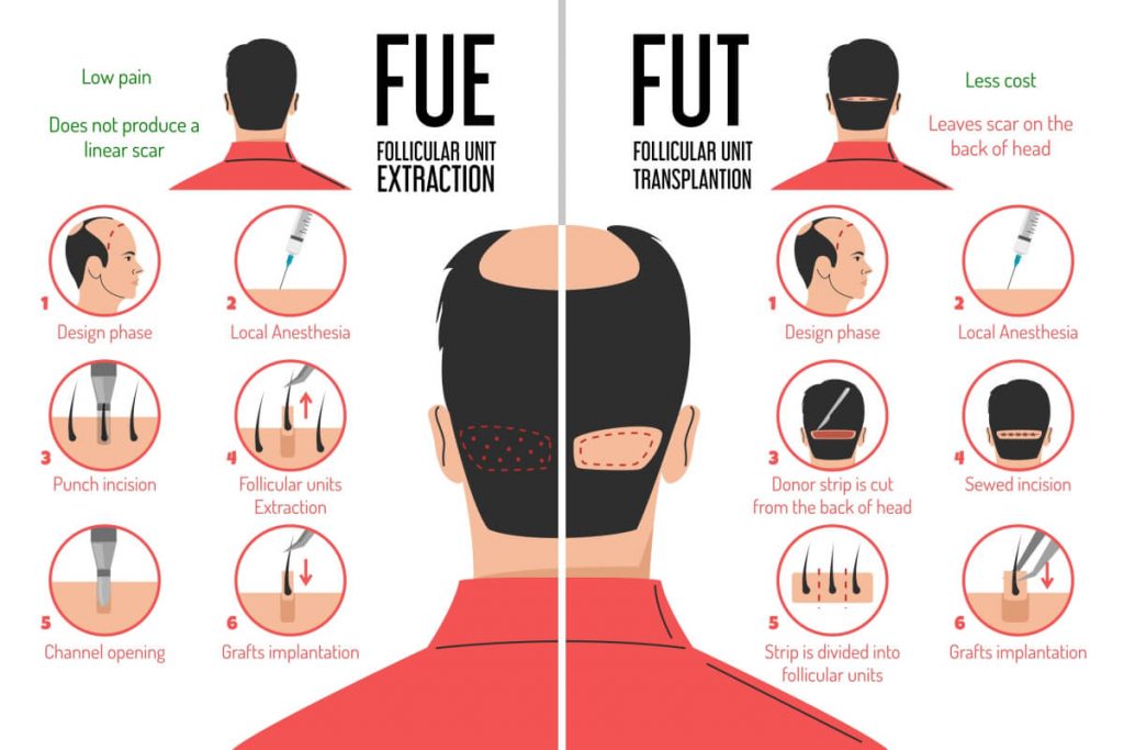FUT and FUE hair transplantation process