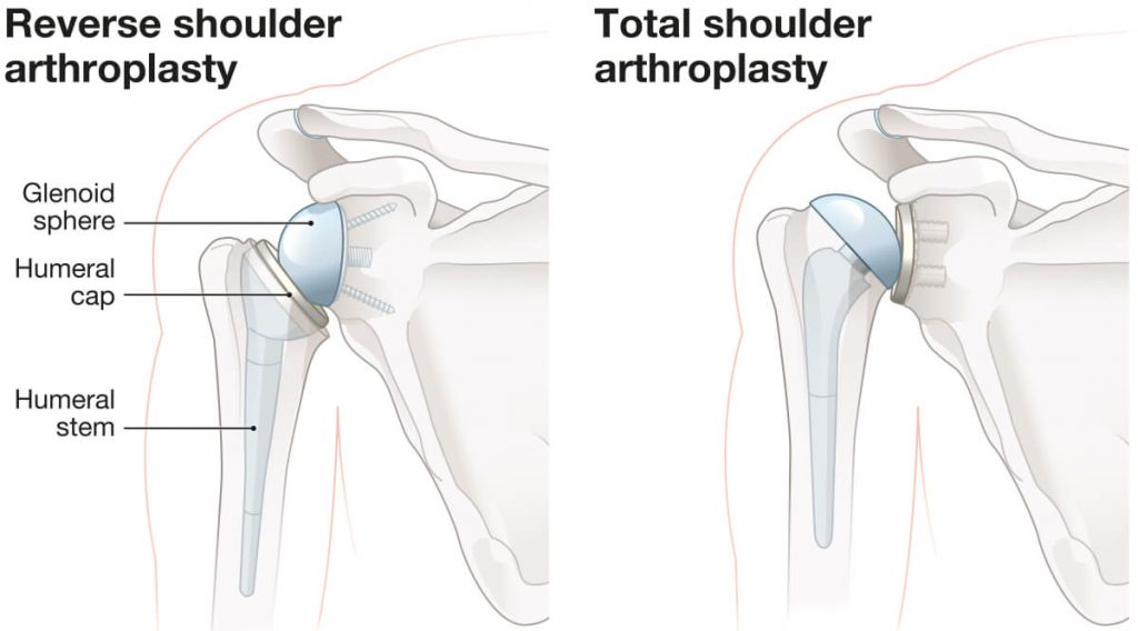 Illustration showing reverse shoulder arthroplasty and total shoulder arthroplasty