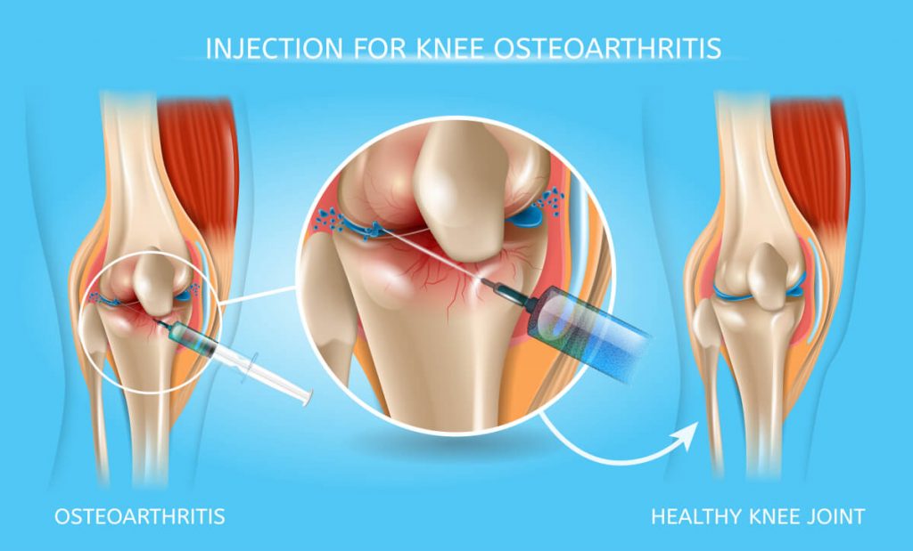 Injection for Knee Osteoarthritis