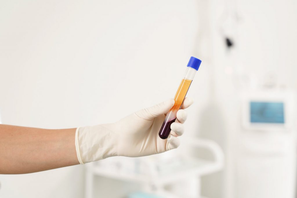 Nurse holding vacutainer with a platelet-rich plasma and blood for PRP treatment