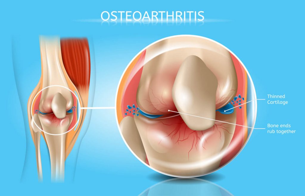 Osteoarthritis