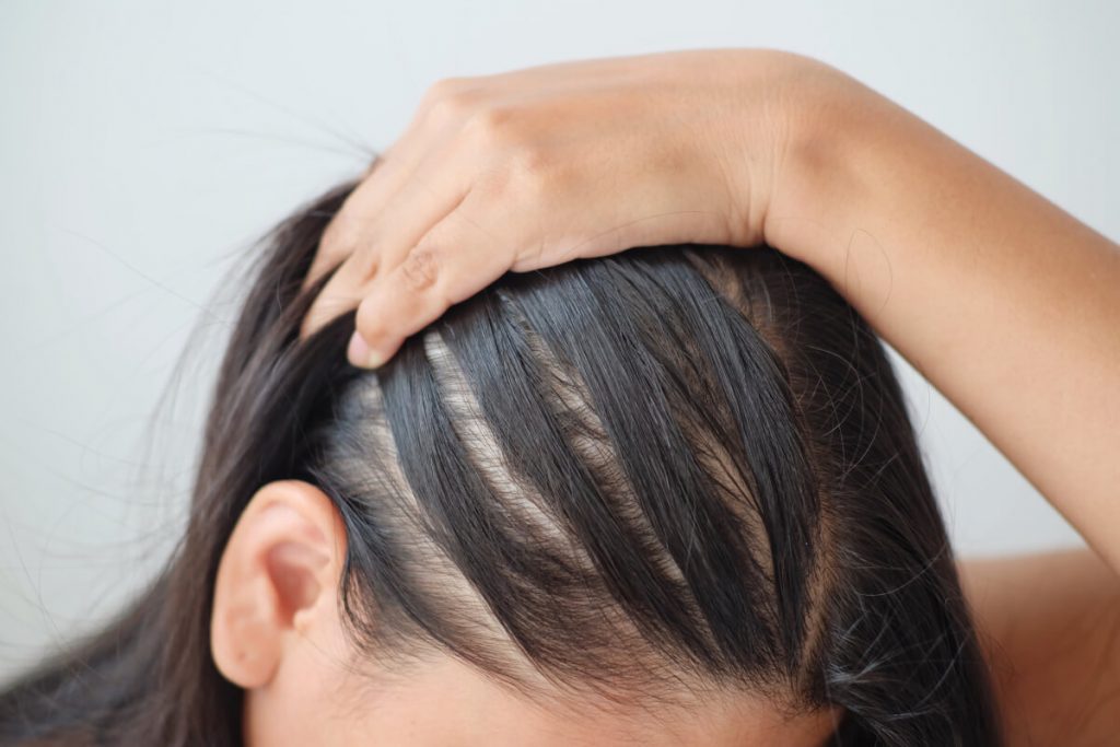 Young asian woman having serious thin hair problem.