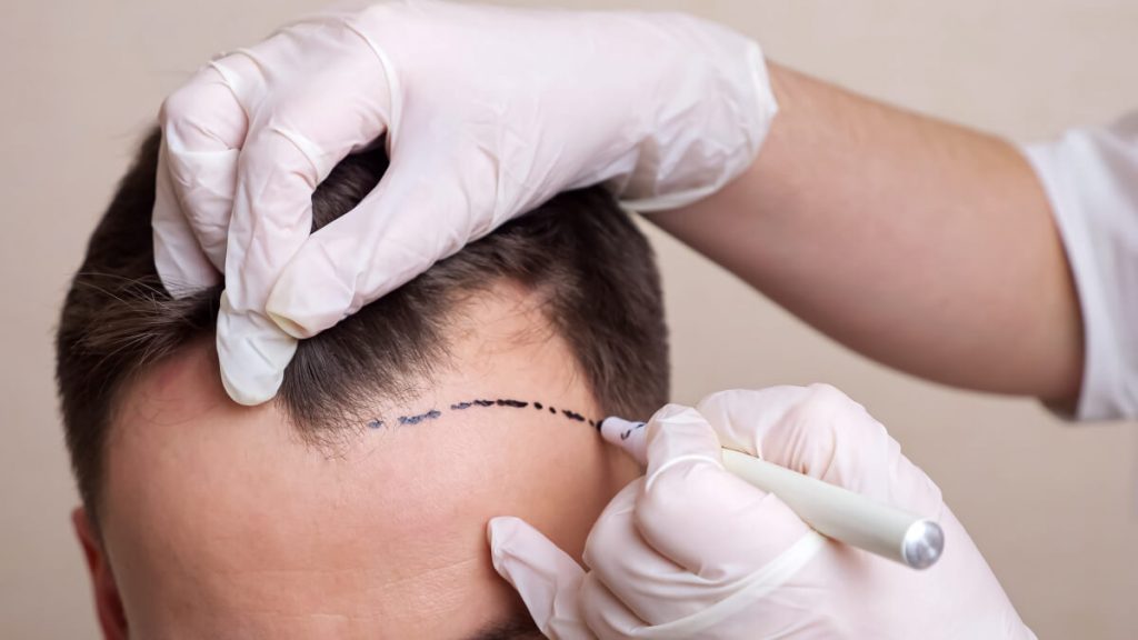 medical professional with gloves draws a dotted line on the head of a balding man.