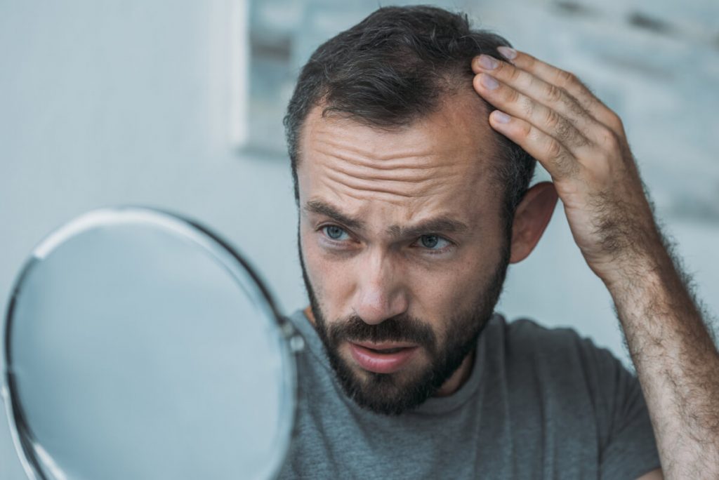 upset middle aged man with alopecia looking at mirror