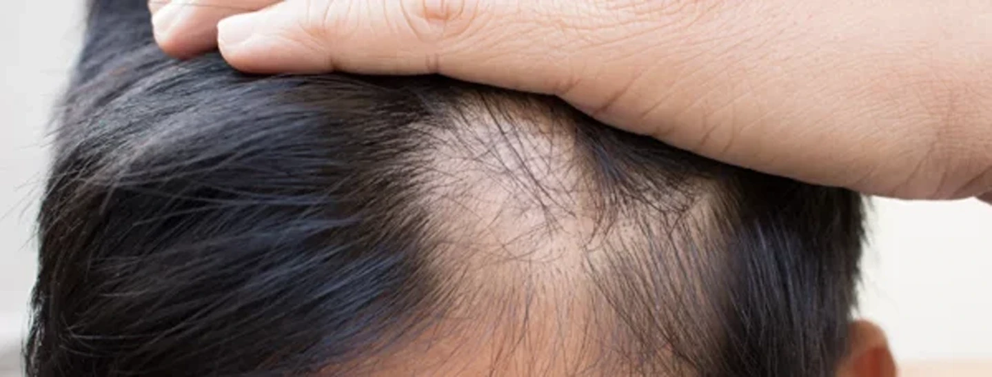 A Guide To PRP Hair Treatment For Male Pattern Baldness