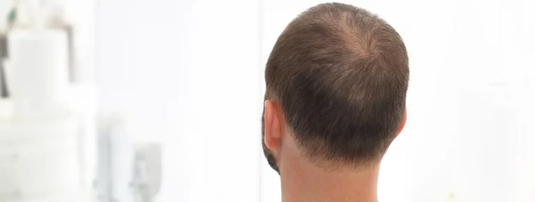 The head of a man with thinning hair