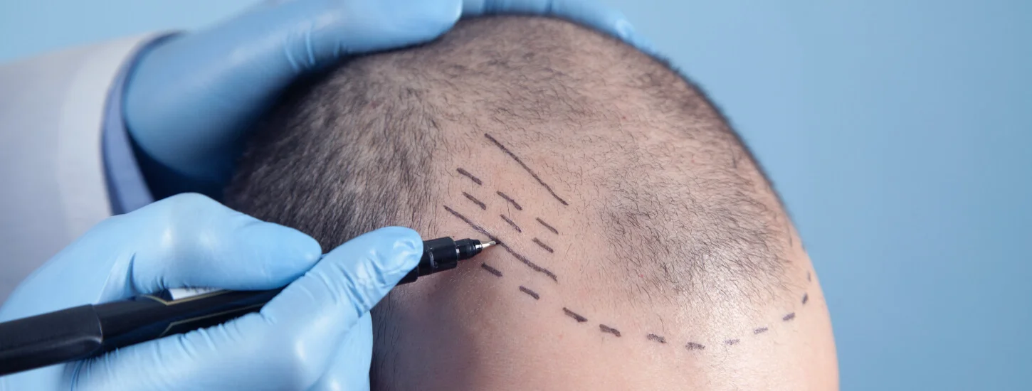 Patient suffering from hair loss in consultation with a doctor