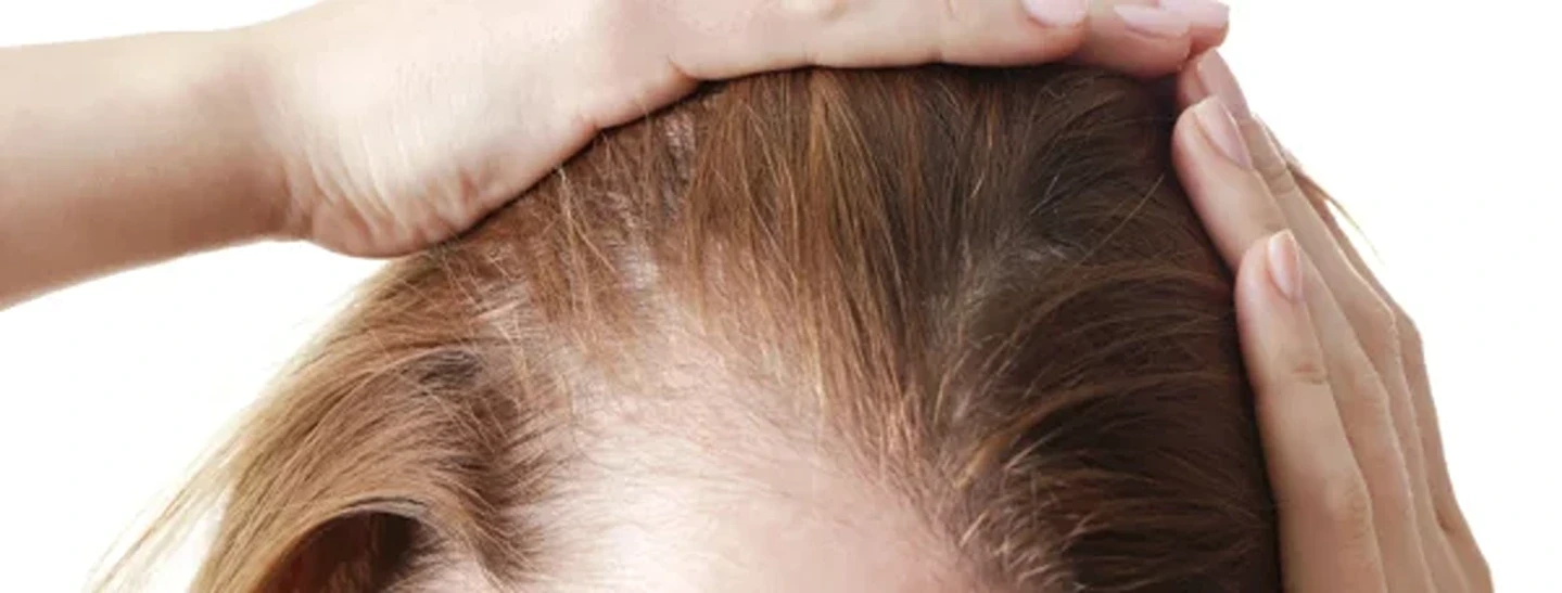 Sjogren’s Syndrome Hair Loss and PRP Injection