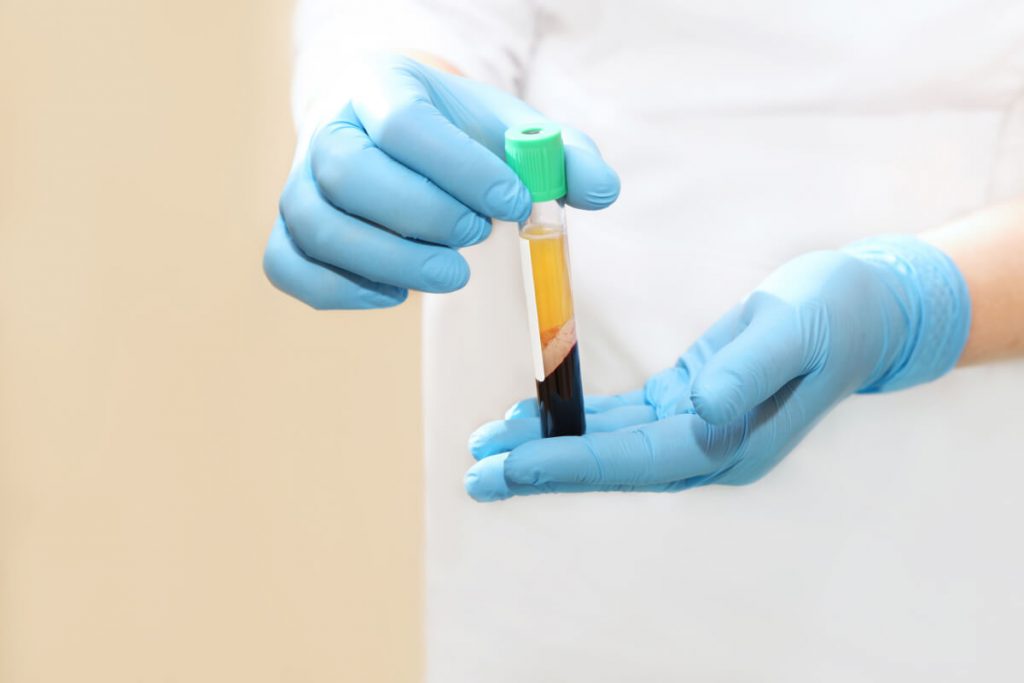 Woman hand in a blue medical holding prp tube