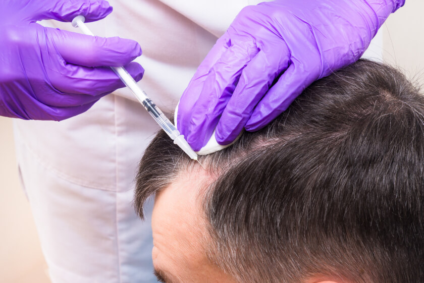 prp Treatment for Hair Loss