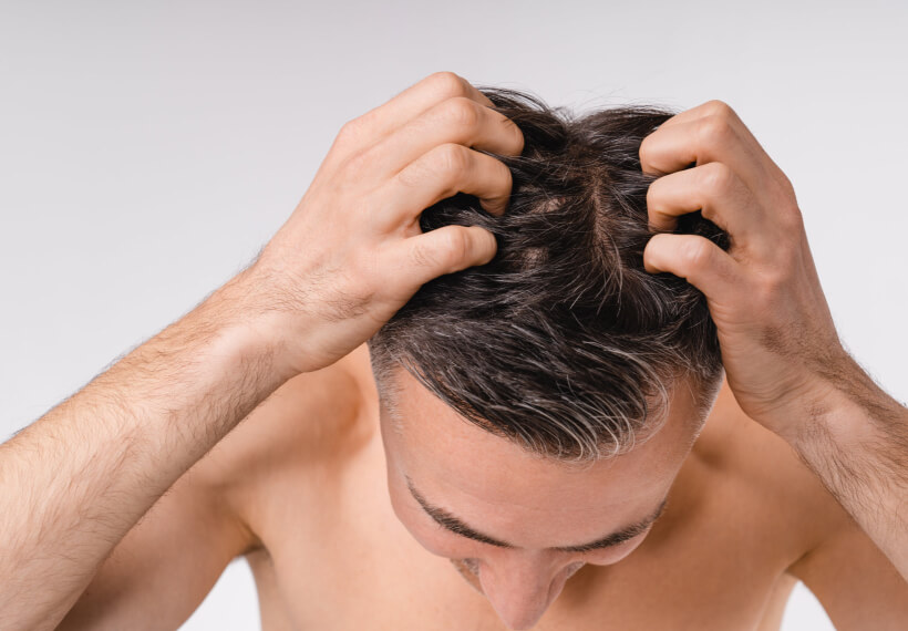 Brown-haired handsome man showing his hairline