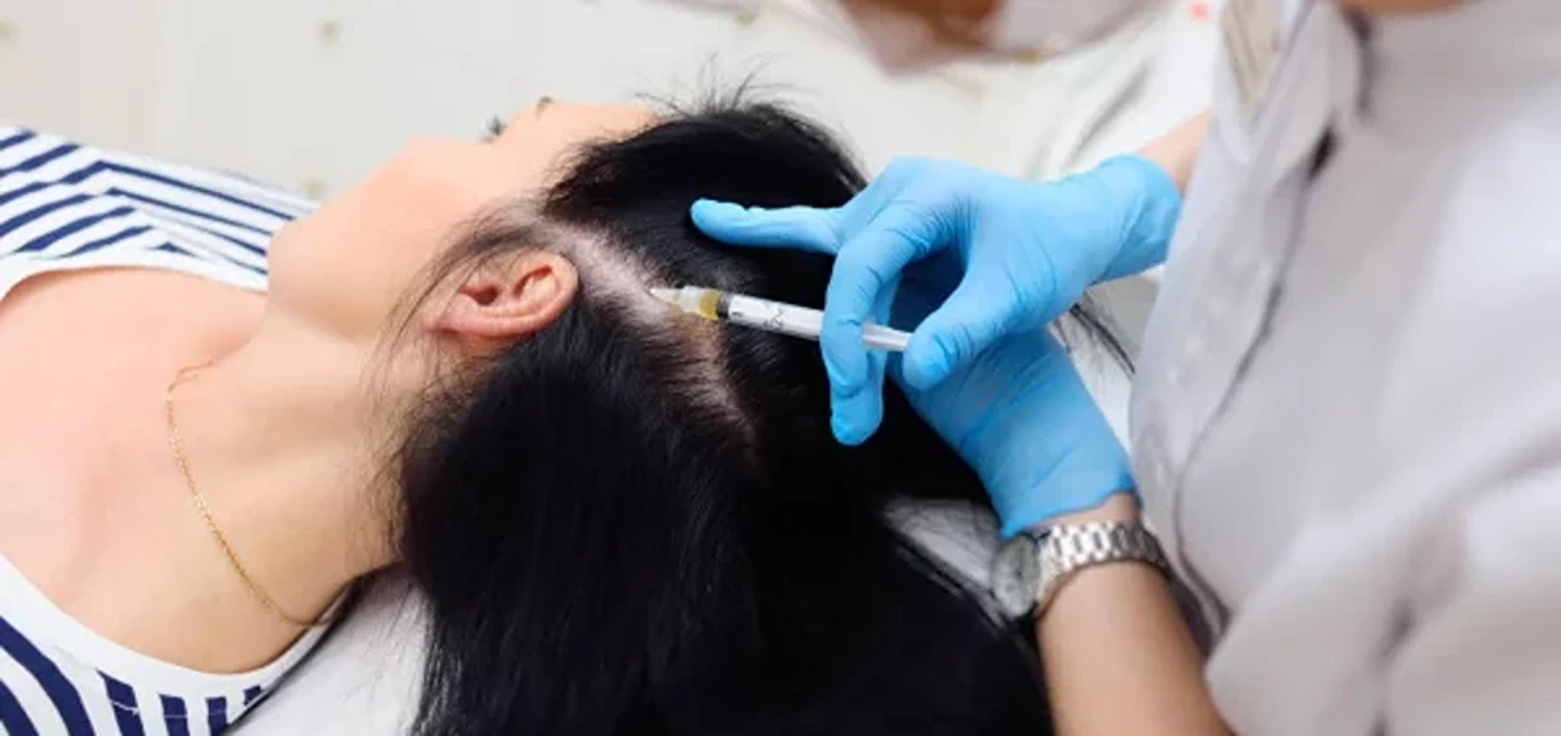 Can You Get Scalp PRP Treatment For Hair Loss If You Have Lupus Hair Loss