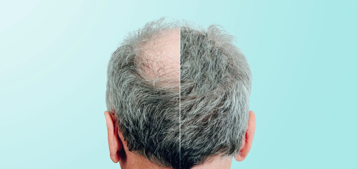 hair loss before and after prp treatment