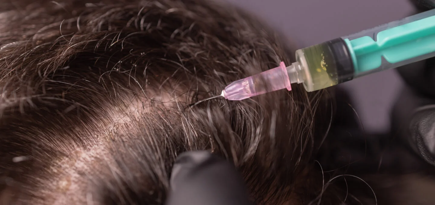 Can You Use a 32-Gauge Needle for PRP Hair Loss Treatment? – Face Med Store