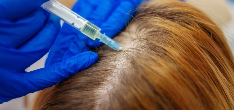 PRP vs PRF treatment for hair loss condition