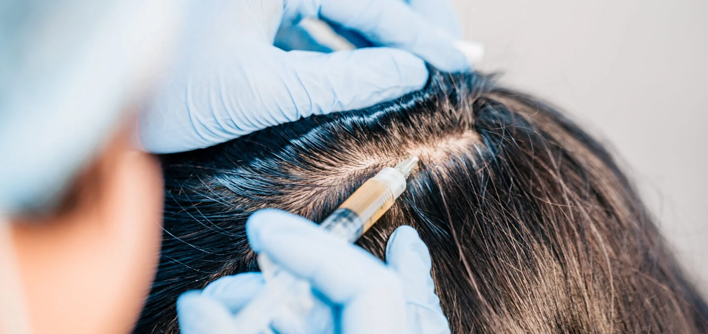 woman getting PRP for hair loss