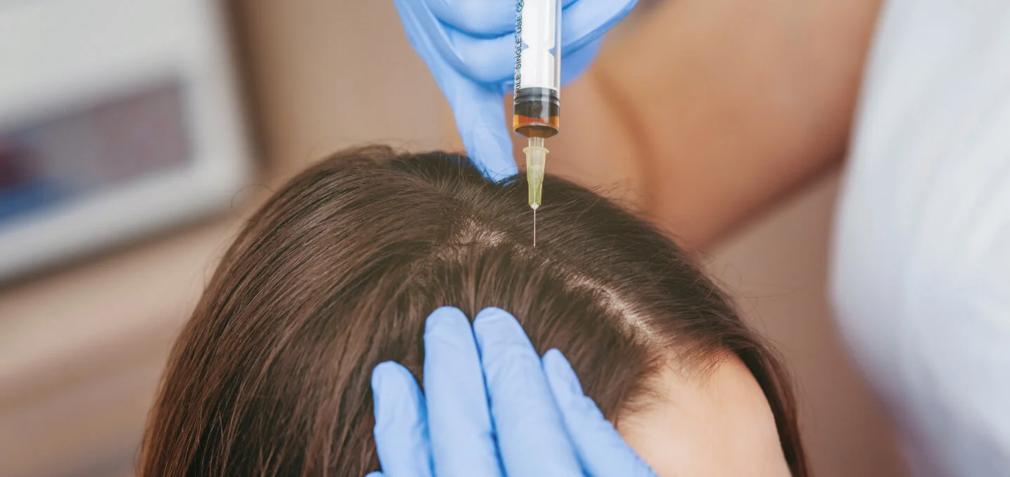woman getting prp hair treatment for hair loss