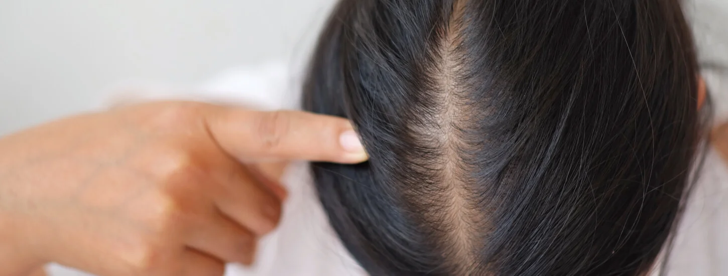 woman suffering hair loss