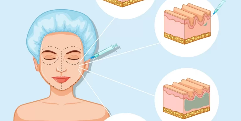 Scientific medical illustration of botox injection