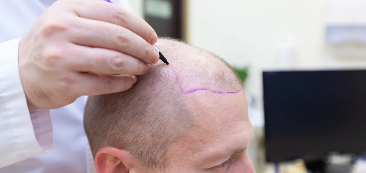 Patient suffering from hair loss in consultation with a doctor.