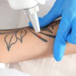 Pigment & Tattoo Laser Removal