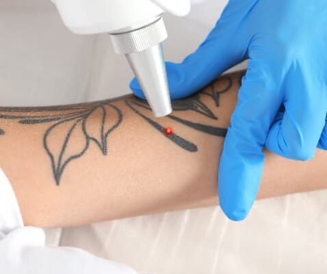 course-featured-pigment-and-tattoo-laser-removal
