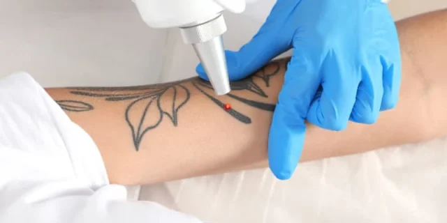 Pigment & Tattoo Laser Removal